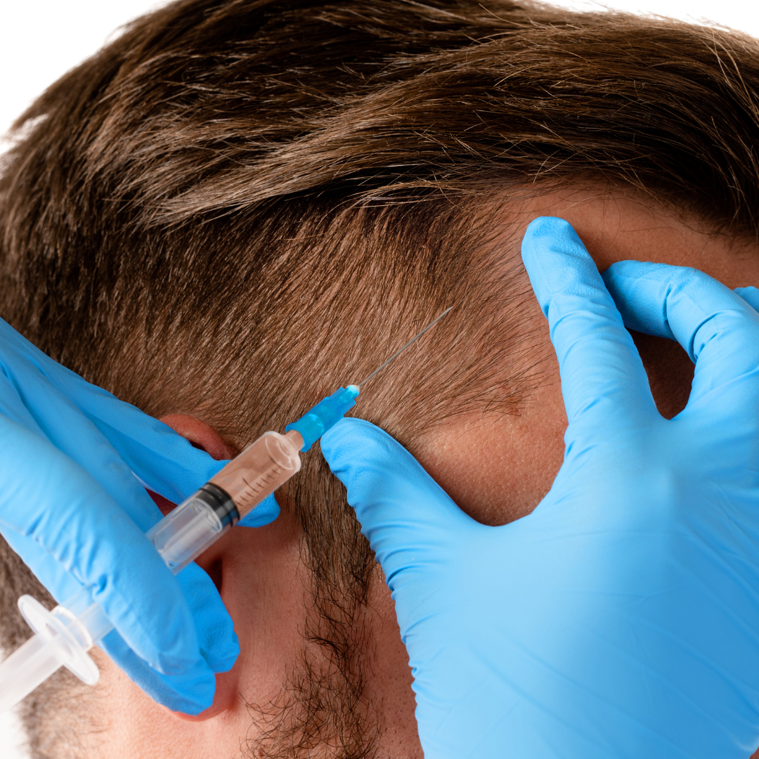 PRP Treatments for Hair in Toronto